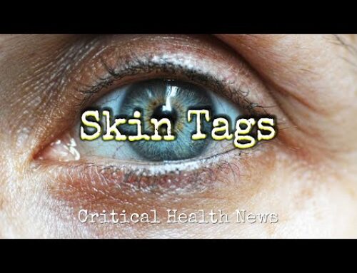 Skin Tags